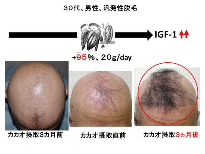 円形脱毛症　病院